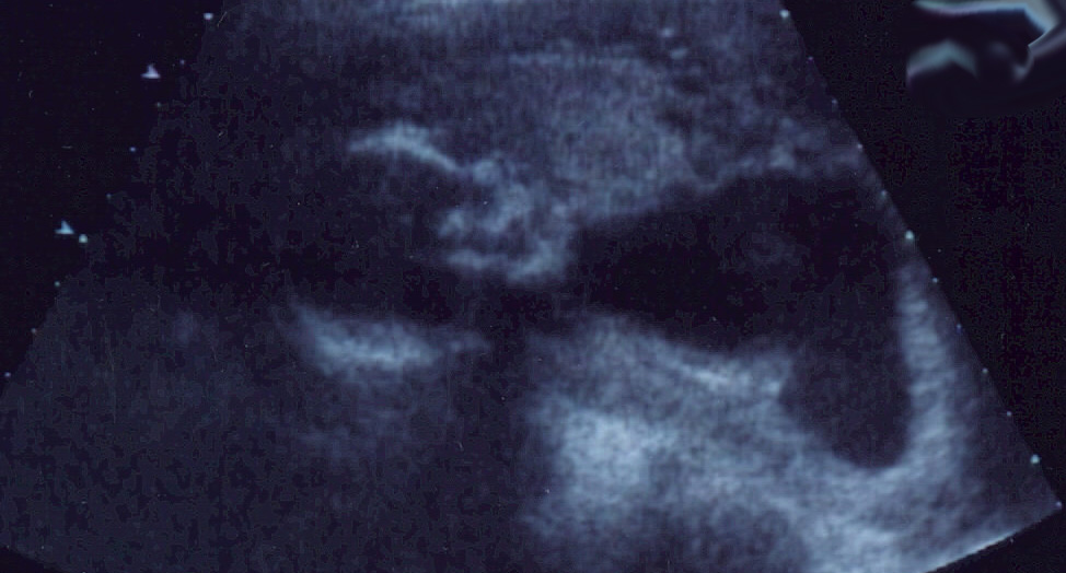 Edelet Ultrasound2