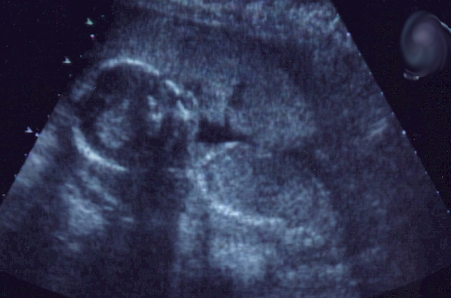 Edelet Ultrasound3